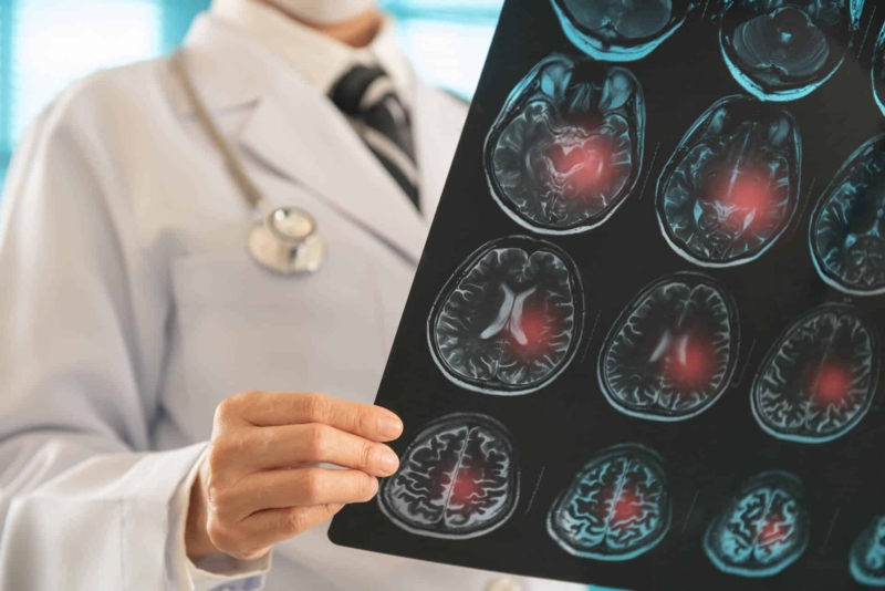 Ein Arzt in weißem Kittel hält MRT-Aufnahmen eines Gehirns in den Händen; mehrere Bereiche auf den Bildern sind rot markiert.