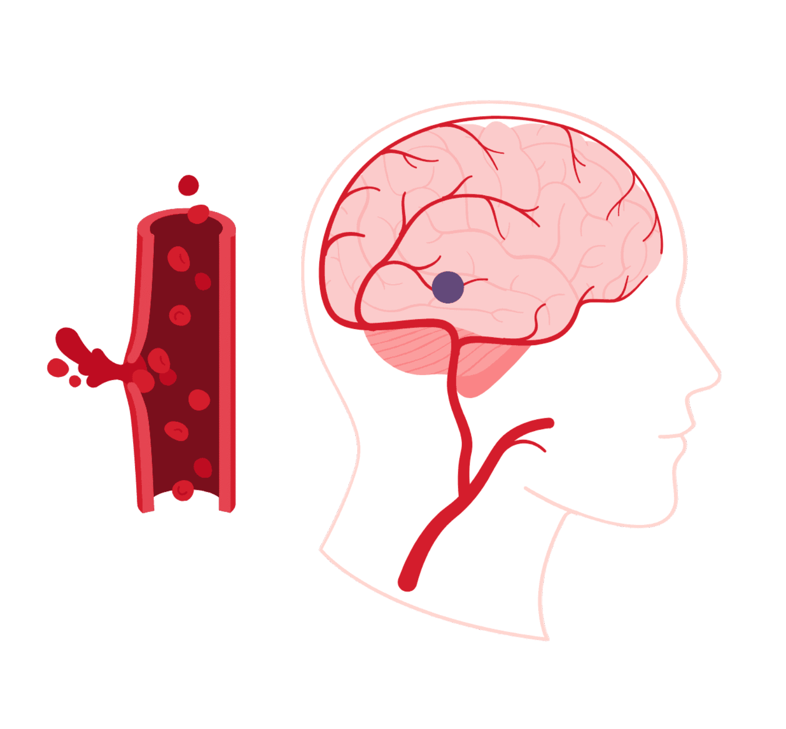 Illustration eines Schlaganfalls. Es wird eine Hirnblutung gezeigt. Ein geplatztes Blutgefäß im Gehirn verursacht eine Blutung, die als dunkler Bereich im Gehirn dargestellt ist.