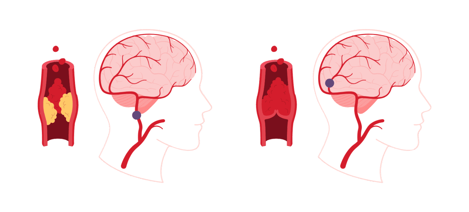 Illustration eines Schlaganfalls: Es wird ein Hirninfarkt durch ein verstopftes Blutgefäß dargestellt. Also wenn ein Blutgerinnsel oder Plaque den Blutfluss zu einer Arterie im Gehirn beeinträchtigt.
